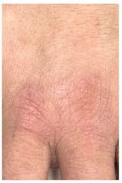 יבלות ויראליות - אחרי