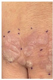 יבלות ויראליות - לפני