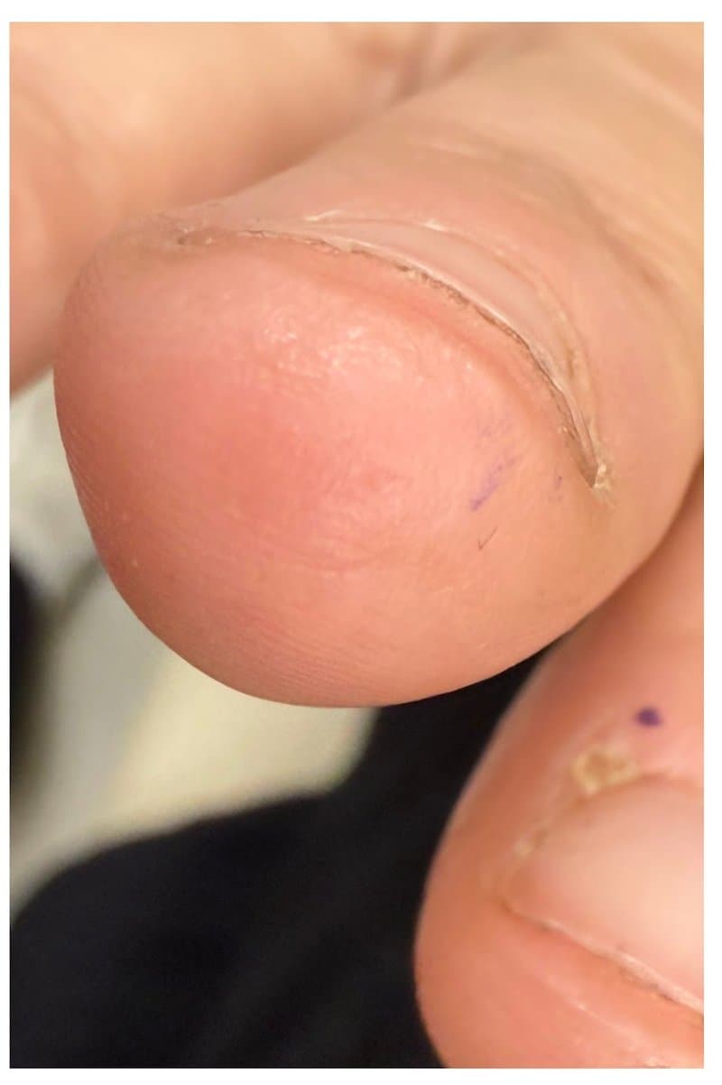 יבלת ויראלית - אחרי