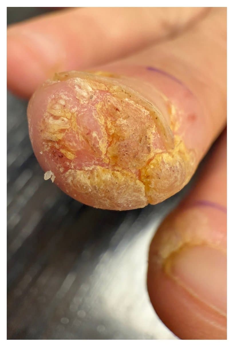 יבלת ויראלית - לפני