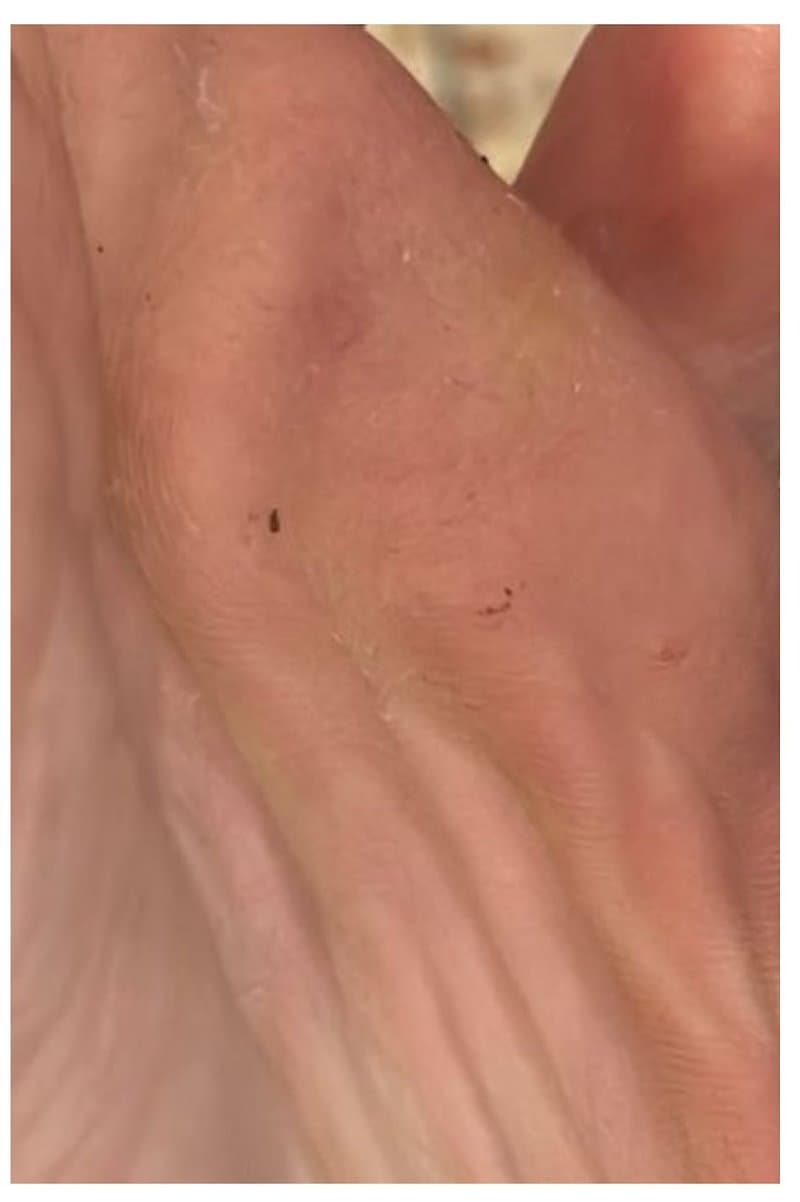 יבלת פלנטרית - אחרי