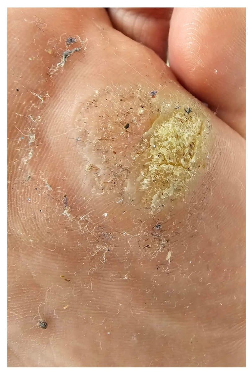 יבלת פלנטרית - לפני