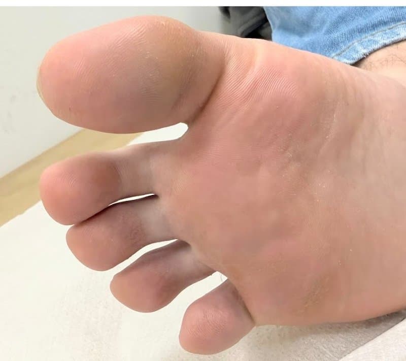 יבלות פלנטריות - אחרי