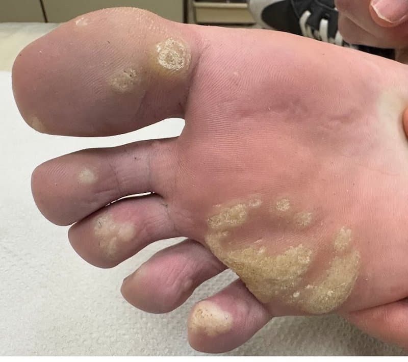 יבלות פלנטריות - לפני